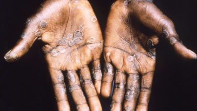 Photo of Monkeypox: How it spreads, who’s at risk – here’s what you need to know